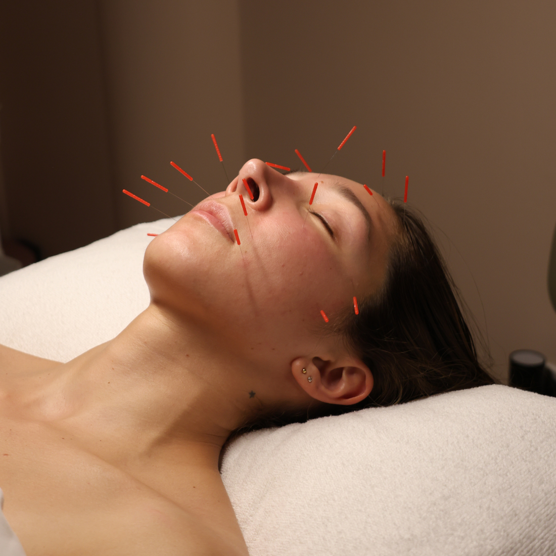 Cosmetic Acupuncture: A Natural Approach to Glowing, Healthy Skin